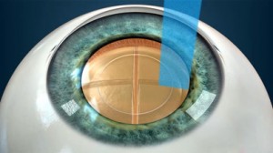 Intervento Cataratta