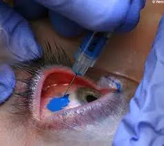 EYEBALL TATOO TECHNIC