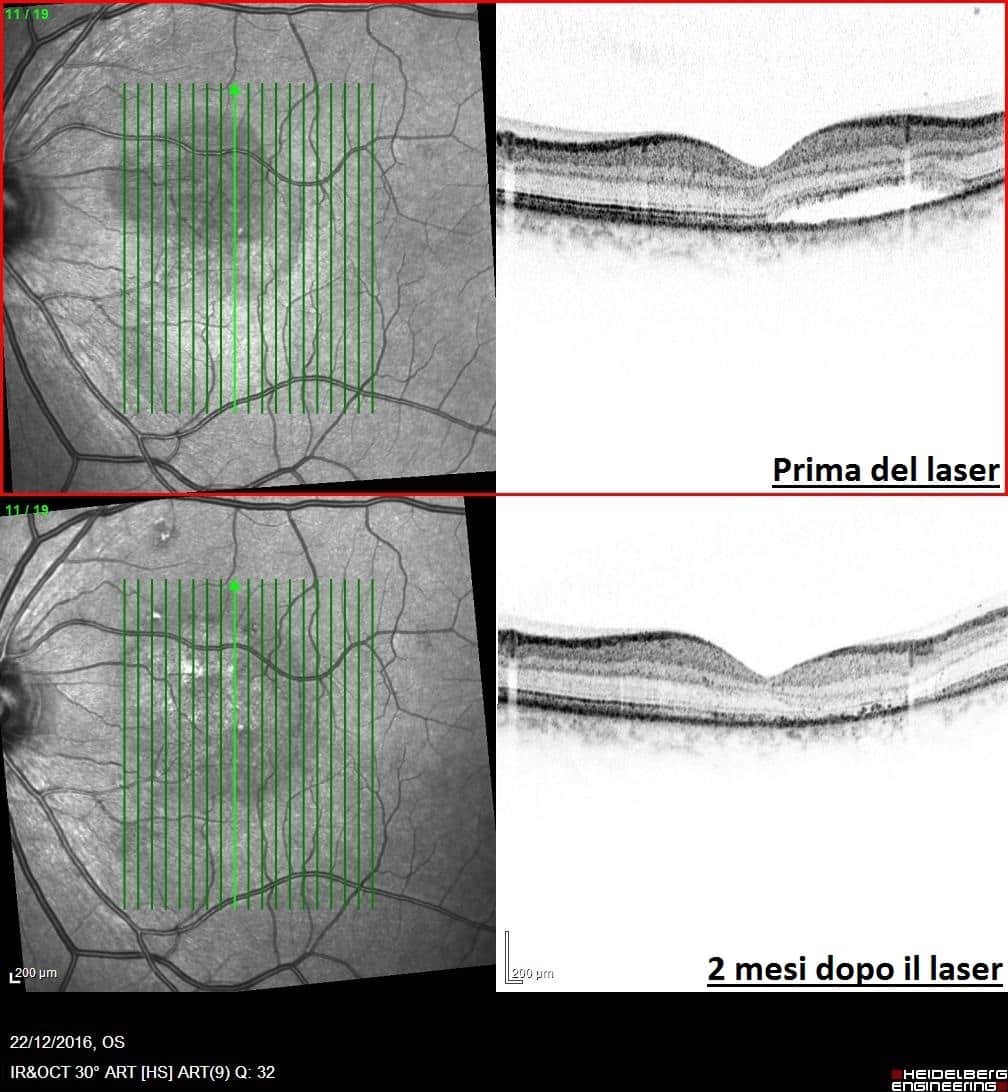 laser giallo prima e dopo