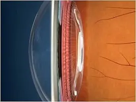 Maculopatia: EyeMax, la Nuova Terapia