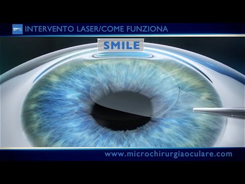 Intervento Laser Occhi: Come Funziona e Quali Novità