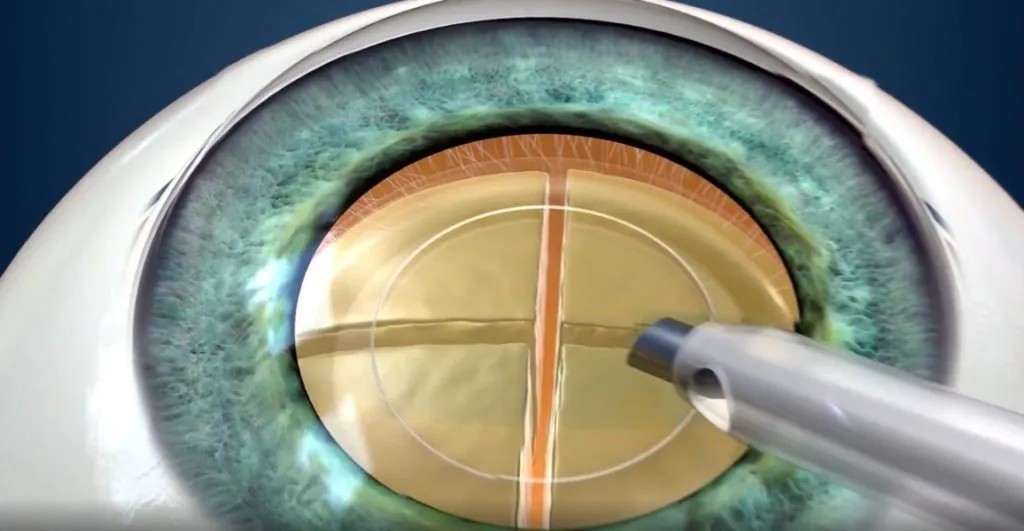 Cataract Surgery: All the Latest News