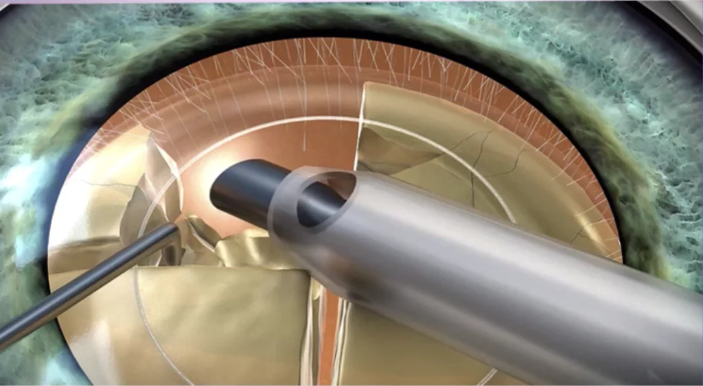 Intervento di Cataratta: Cosa Succede Prima, Durante e Dopo.