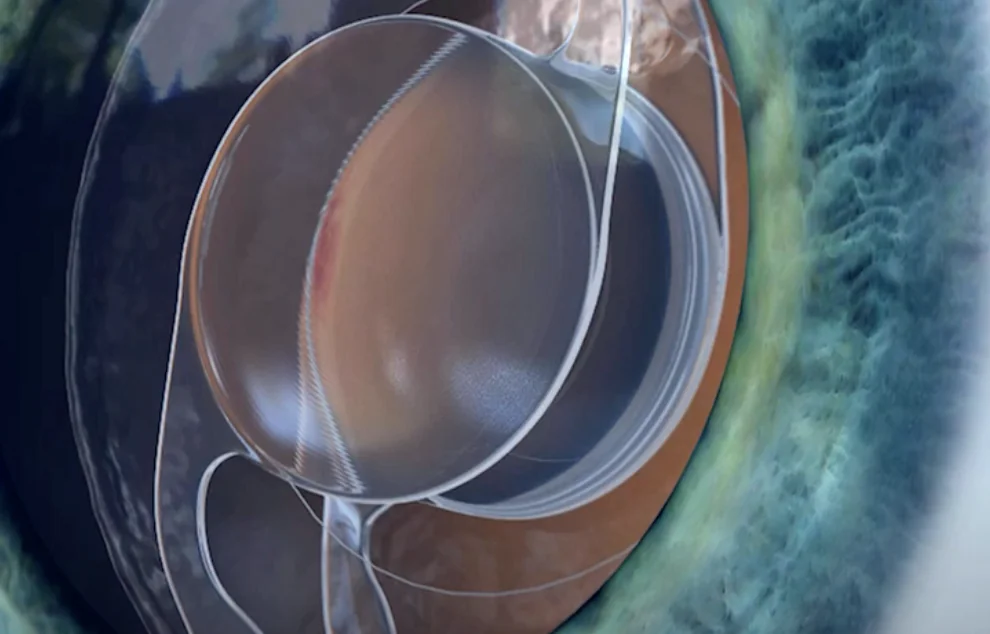 EyeMax e Maculopatia: Come Funziona la Nuova Terapia